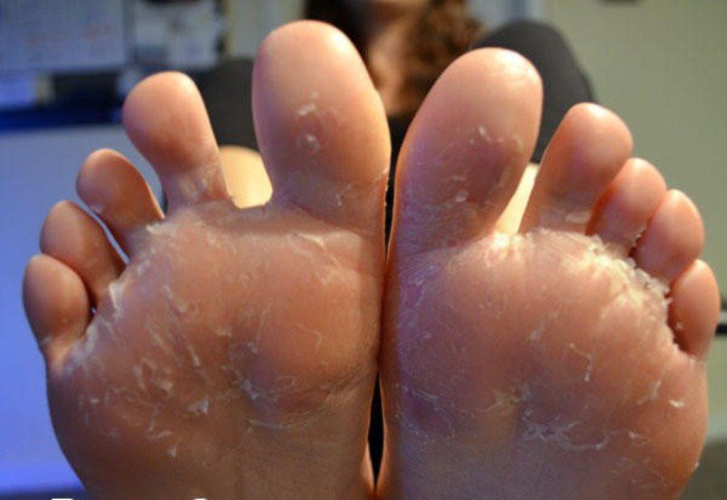 Peeling-feet