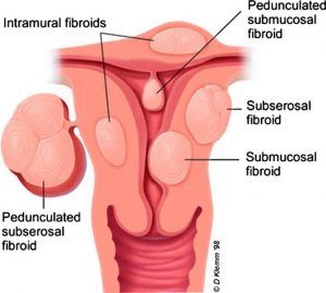 uterus-diagram-jpeg