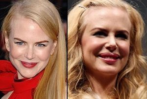 nicole-kidman-and-after-plastic-surgery-facelift-botox-lip-implants1